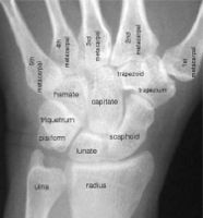X-ray of the wrist with bone names